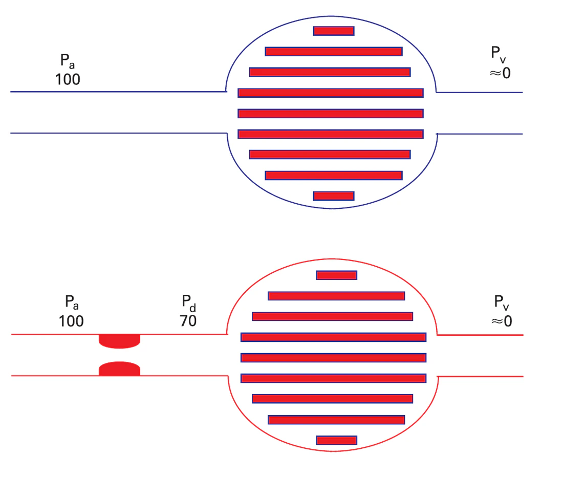 Diagrama comparando uma artéria sem obstrução, em que a pressão se mantém em 100 até o músculo cardíaco, com uma artéria com estenose, em que a pressão cai de 100 para 70 depois da obstrução