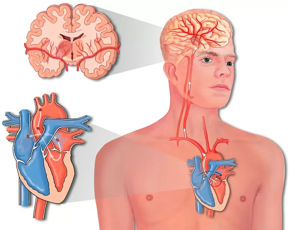 Ilustração da embolia paradoxal: um coágulo atravessa o coração pelo forame oval patente e sobe até uma artéria do cérebro, causando AVC