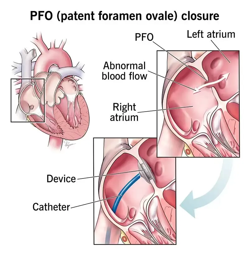 Ilustração do fechamento do forame oval patente: um cateter posiciona uma prótese de dois discos no septo entre os átrios, selando o fluxo anormal de sangue