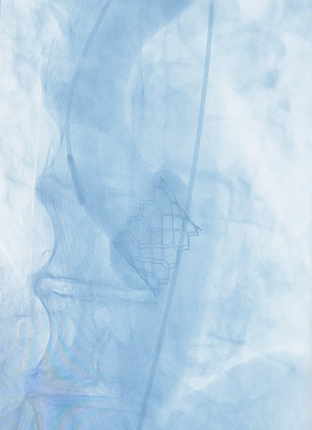 Fluoroscopia de uma prótese valvar implantada na valva aórtica