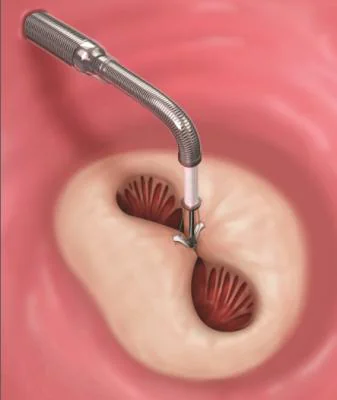 Vista da valva mitral a partir do átrio esquerdo, com o clipe unindo os folhetos anterior e posterior e formando dois orifícios