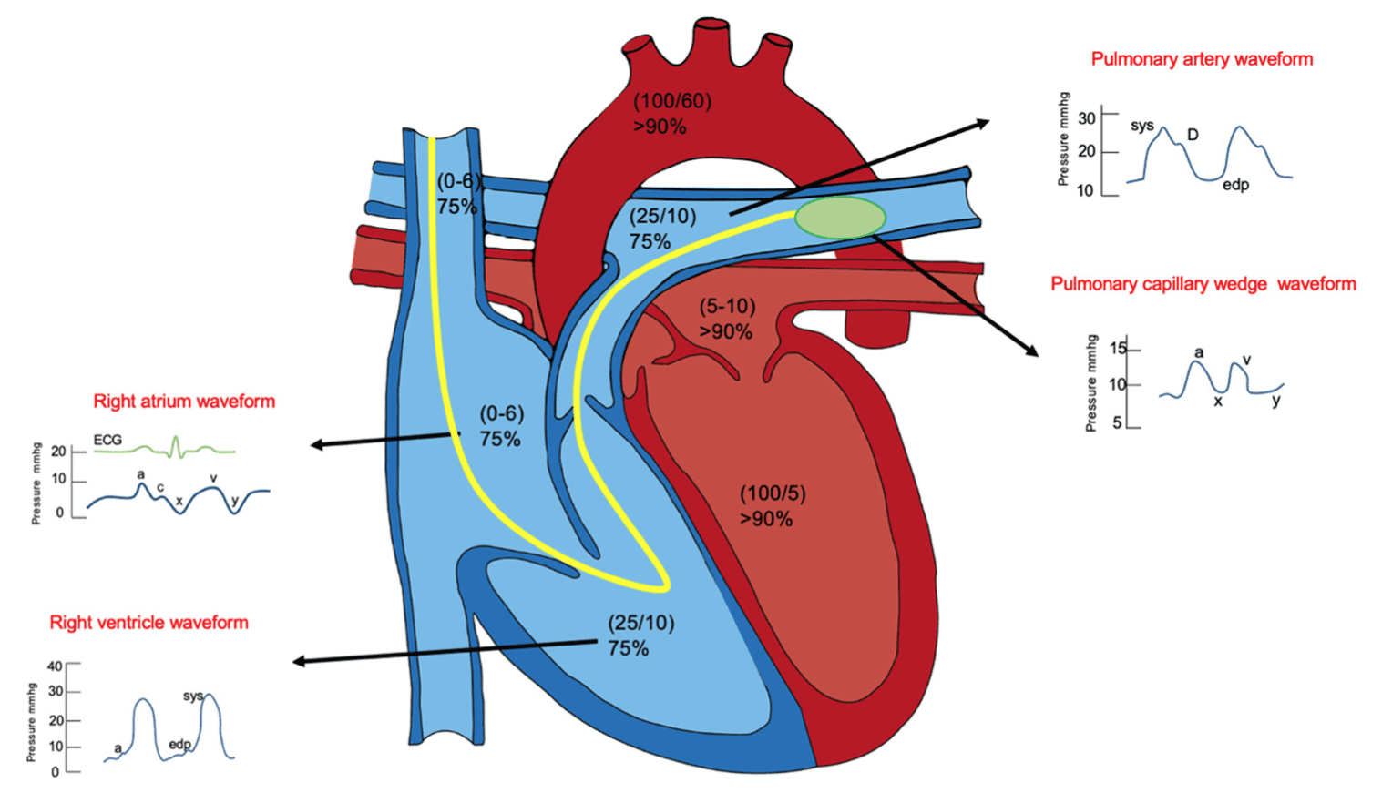 Desenho de um coração durante o procedimento de cateterismo direito. 