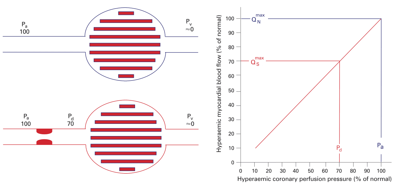 Desenho esquemático para ilustrar a reserva de fluxo fracionada (FFR).