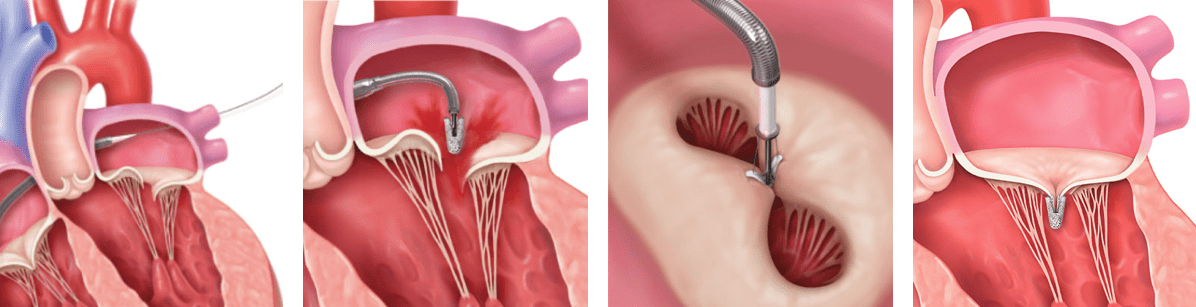 Ilustração do procedimento de TEER da valva mitral