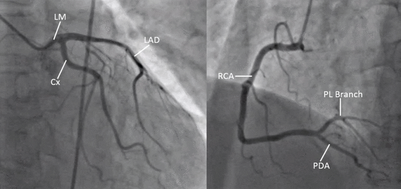 Cateterismo Cardíaco e Coronariografia: o que você precisa saber?
