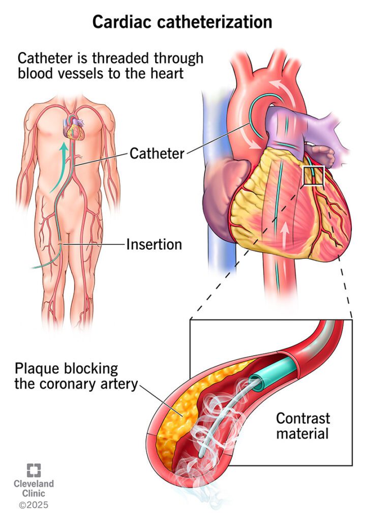 Ilustração de como funciona o cateterismo cardíaco, desde a inserção do cateter, passando pelo trajeto até o coração e chegando nas artérias coronárias, para injeção do contraste. 